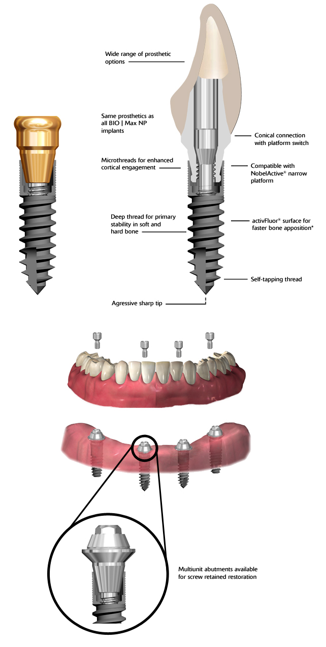 BIO Max Mini Dental Implants Blue Sky Bio